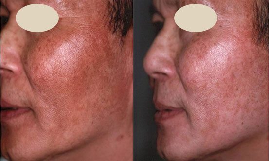 Melasma