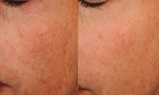 Melasma 3