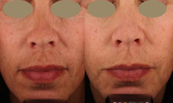 Melasma 4