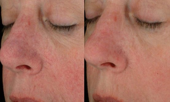 Rosacea 3