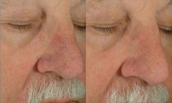 Rosacea 1