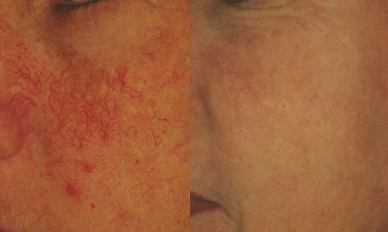 Rosacea 9