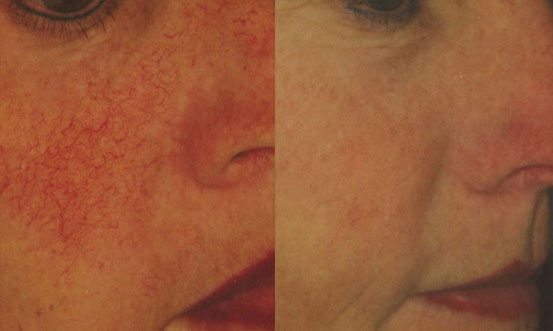 Rosacea 8