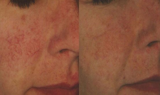 Rosacea 7