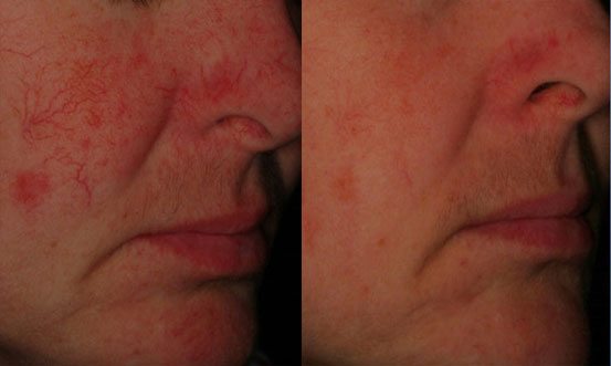 Rosacea 6