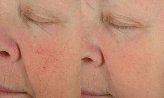 Rosacea 4