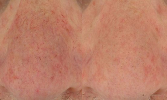 Rosacea 5